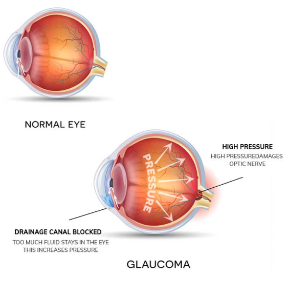 Demonstration of glaucoma symptoms. High pressure and canal blockage inside the eyes.